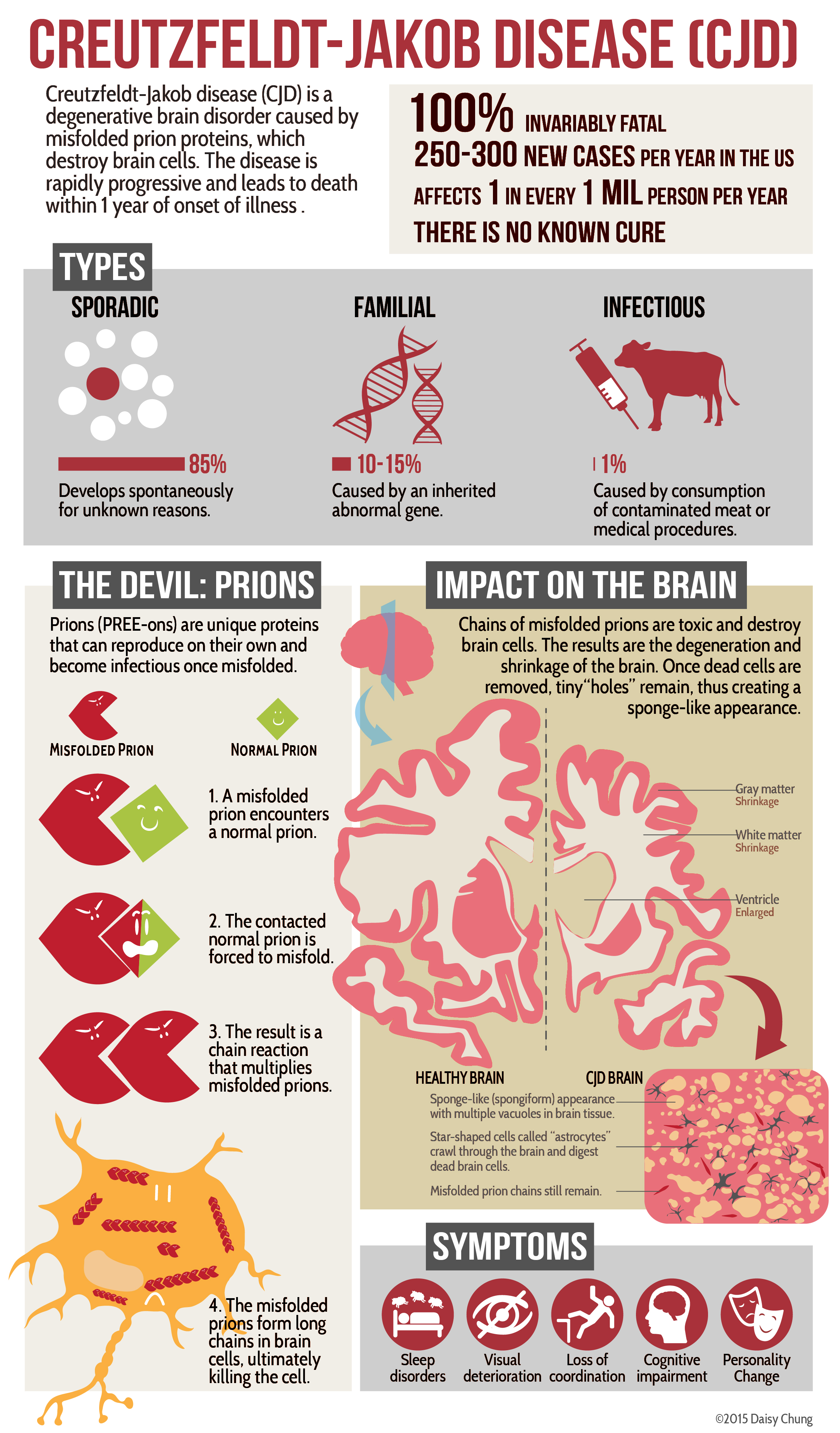 Creutzfeldt Jakob Disease Brain